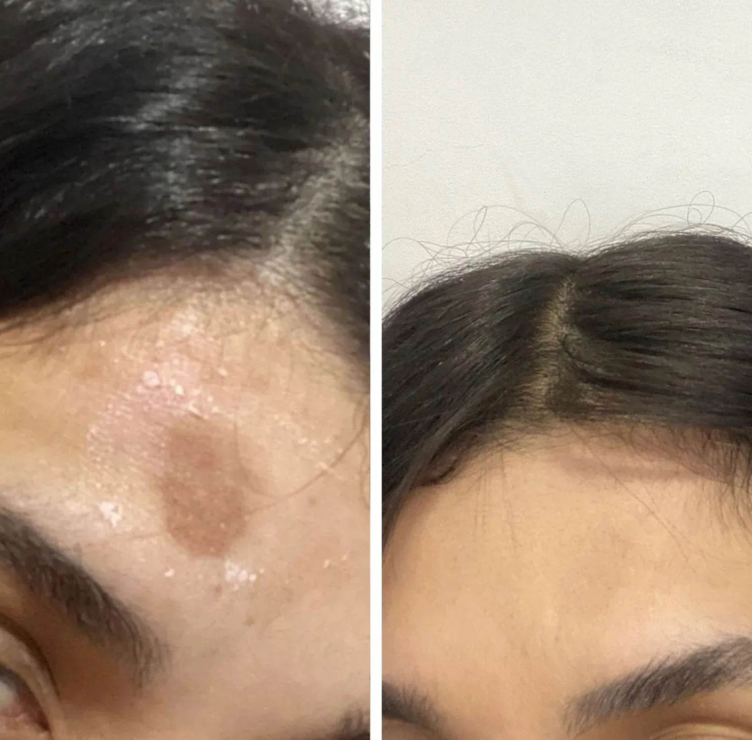 Antes e depois — manchas na testa